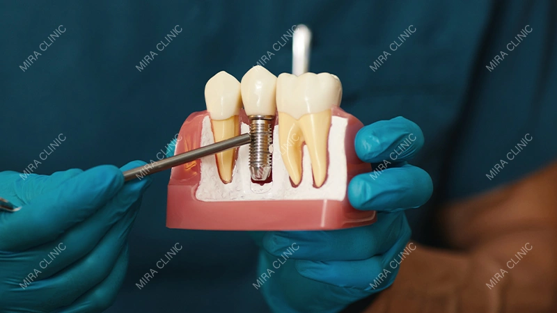 Dental Implant Treatment